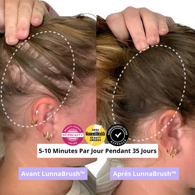 Lunna™ - solution avancée contre la perte de cheveux